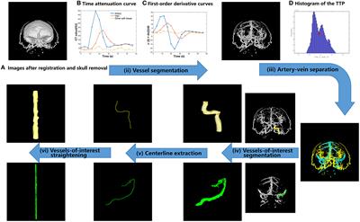 A task-driven cerebral angiographic imaging based on CT perfusion